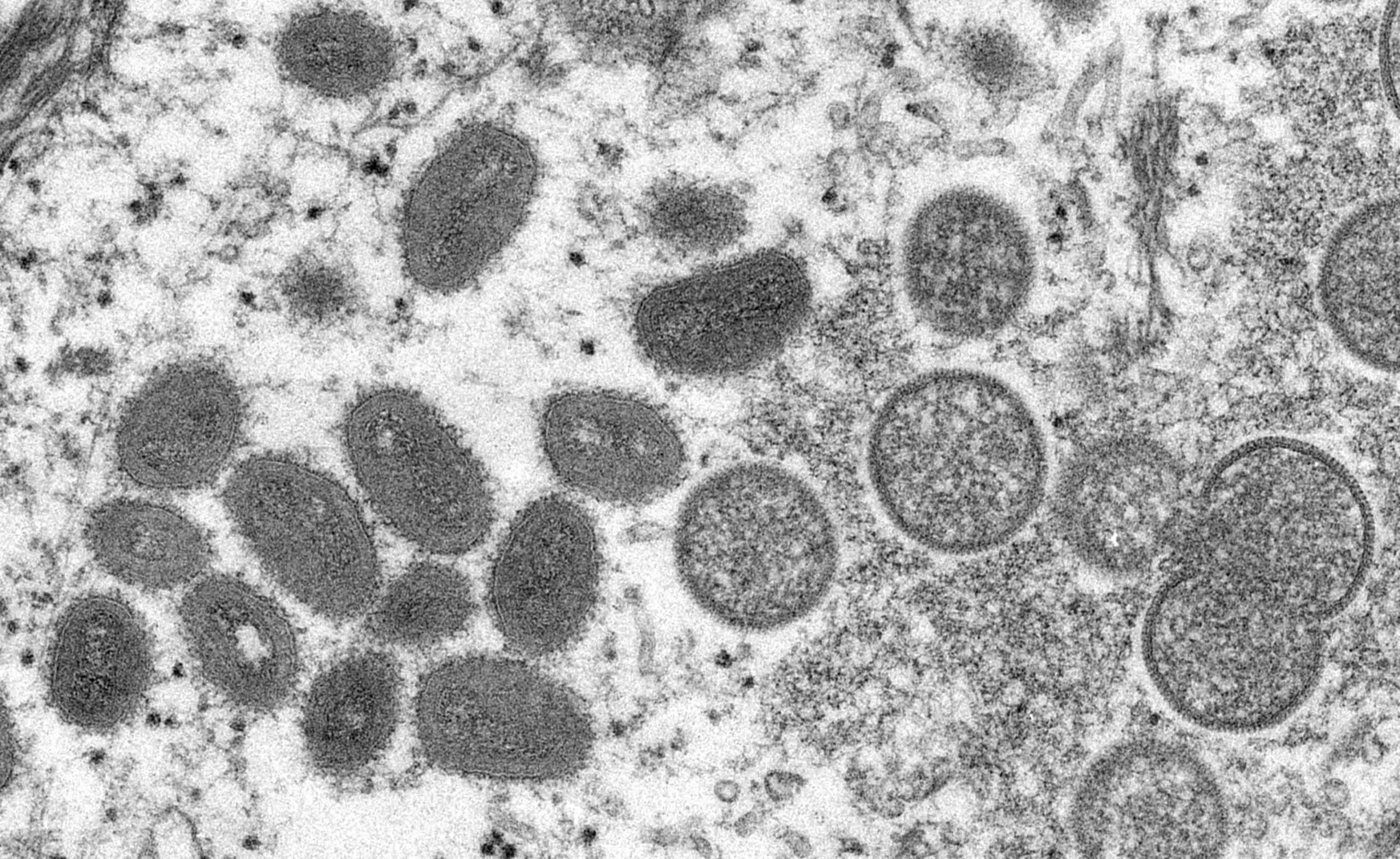 Bahrain reports first case of monkeypox virus
